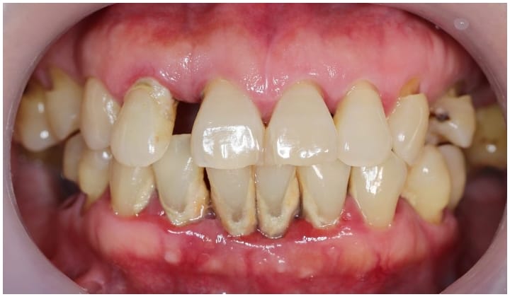 Doktor Kongsi 4 Kebaikan Scaling Gigi Untuk Kesihatan Diri