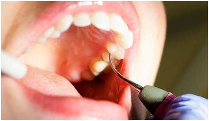 Doktor Kongsi 4 Kebaikan Scaling Gigi Untuk Kesihatan Diri