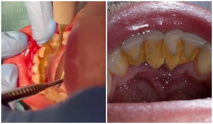 kelebihan scaling gigi
